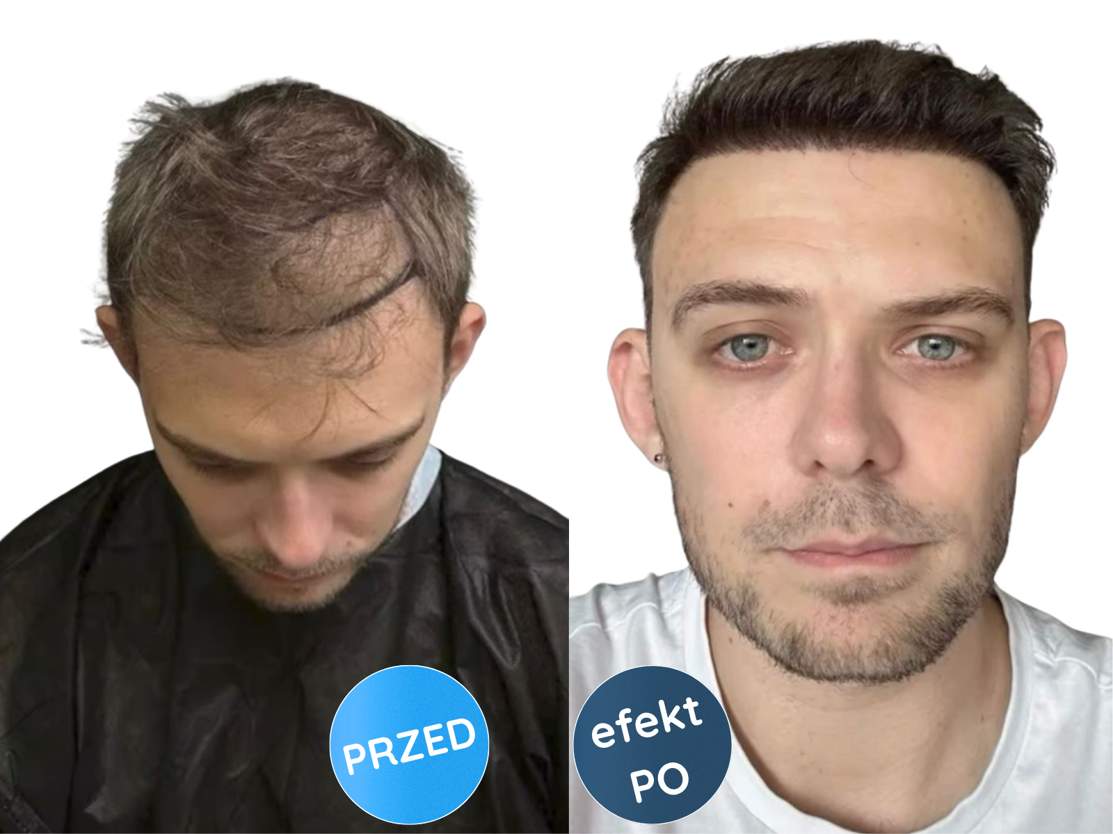 Przed i po: przerzedzenie i pełne włosy, pacjent w koszuli w kratę, Turkus.