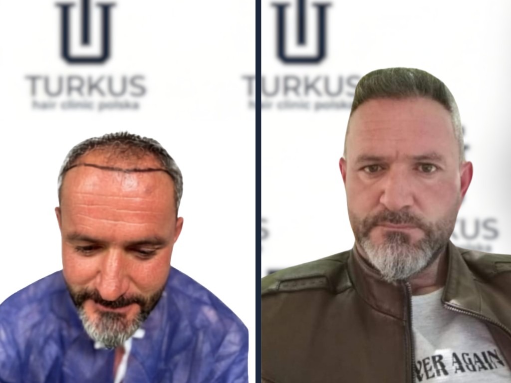 Kacper N. przed i po przeszczepie włosów DHI w Turkus Hair Transplant Clinic.