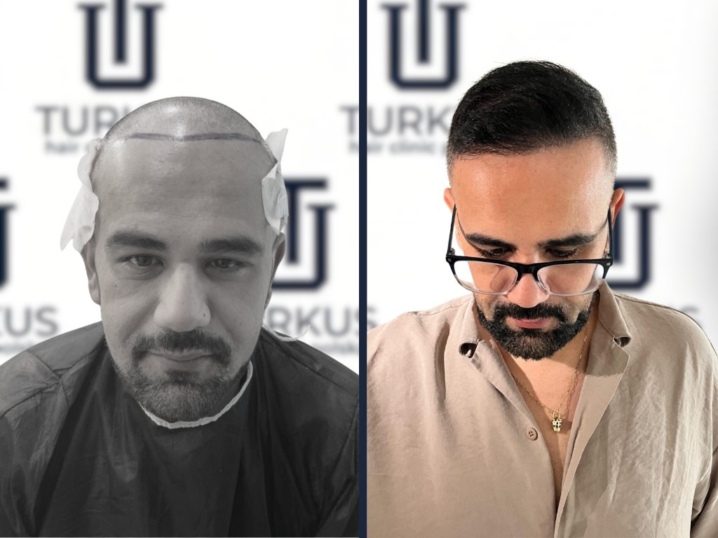 Mateusz K. przed i po przeszczepie włosów FUE w Turkus Hair Transplant Clinic.