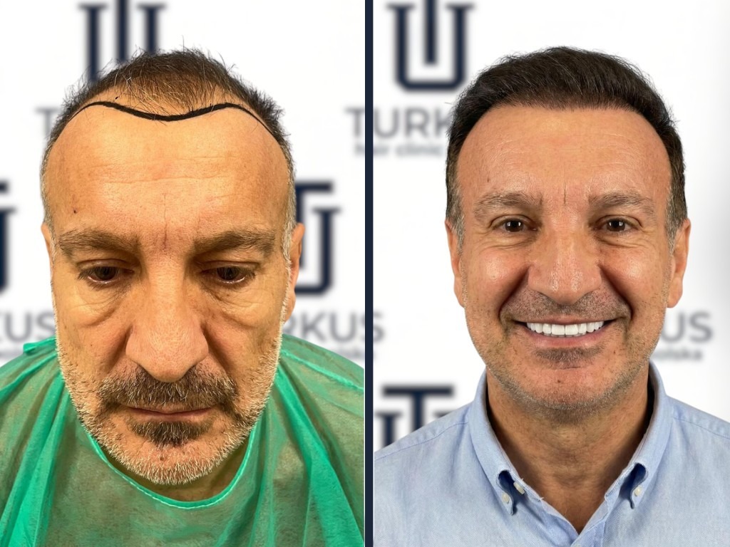 Jakub W. przed i po przeszczepie włosów DHI w Turkus Hair Transplant Clinic.