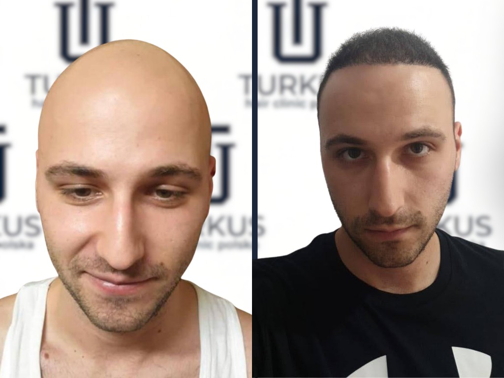 Damian L. przed i po przeszczepie włosów FUE, 4.200 graftów, Norwood 7 w Turkus Hair Transplant Clinic.