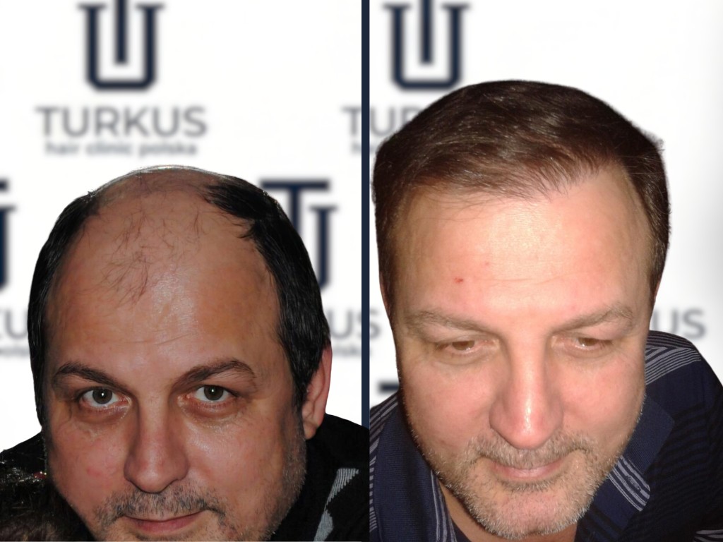 Łukasz G. przed i po przeszczepie włosów FUE, 4.100 graftów, Norwood 6 w Turkus Hair Transplant Clinic.