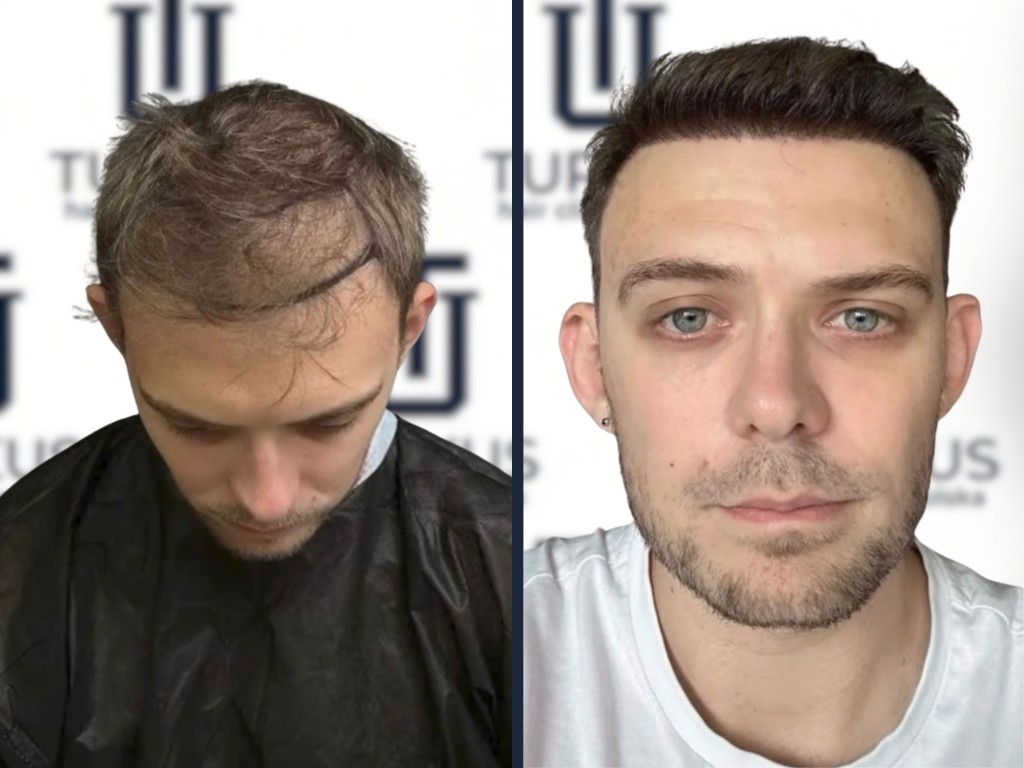 Szymon B. przed i po przeszczepie włosów FUE, 3.950 graftów, Norwood 5 w Turkus Hair Transplant Clinic.
