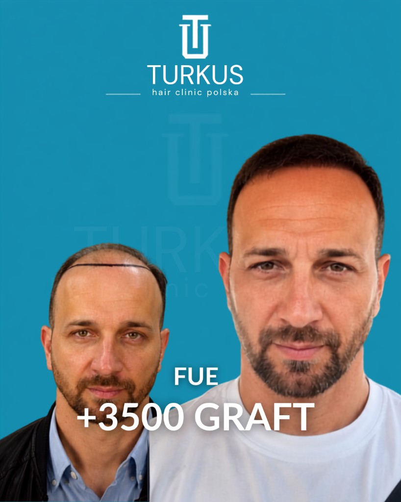 Karol W. przed i po przeszczepie włosów FUE, 3.500 graftów, Norwood 4 w Turkus Hair Transplant Clinic.
