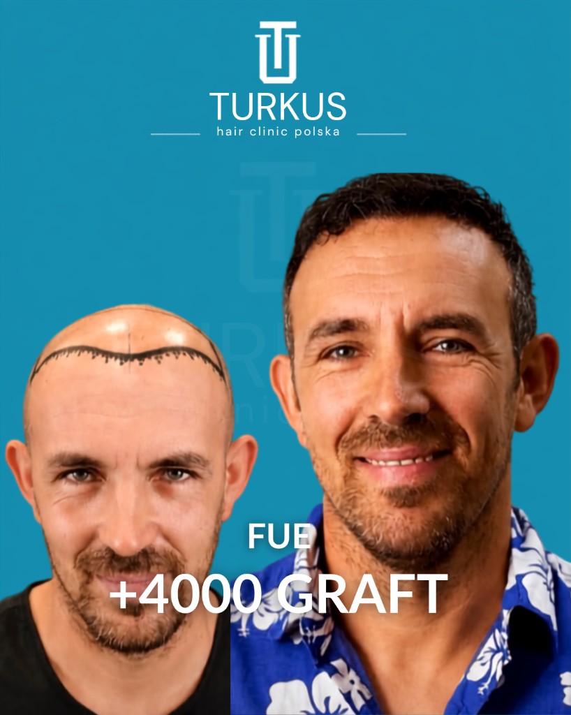 Paweł R. przed i po przeszczepie włosów FUE, 4.000 graftów, Norwood 5 w Turkus Hair Transplant Clinic.