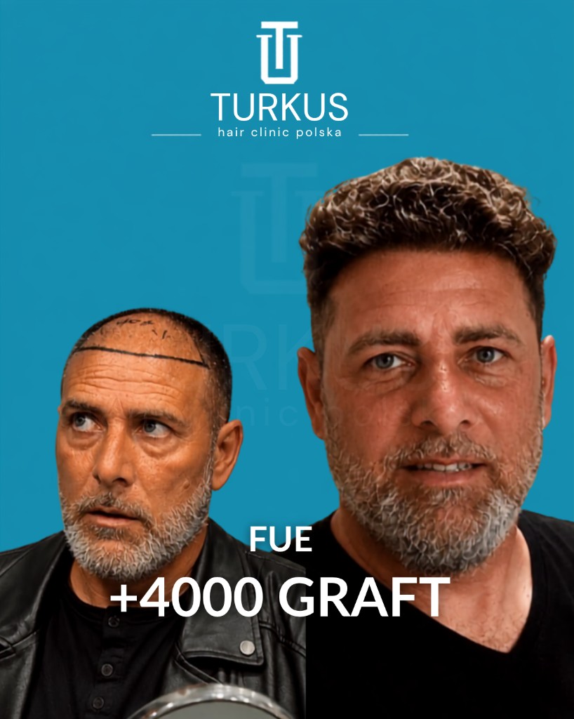Artur N. przed i po przeszczepie włosów FUE, 4.000 graftów, Norwood 5 w Turkus Hair Transplant Clinic.