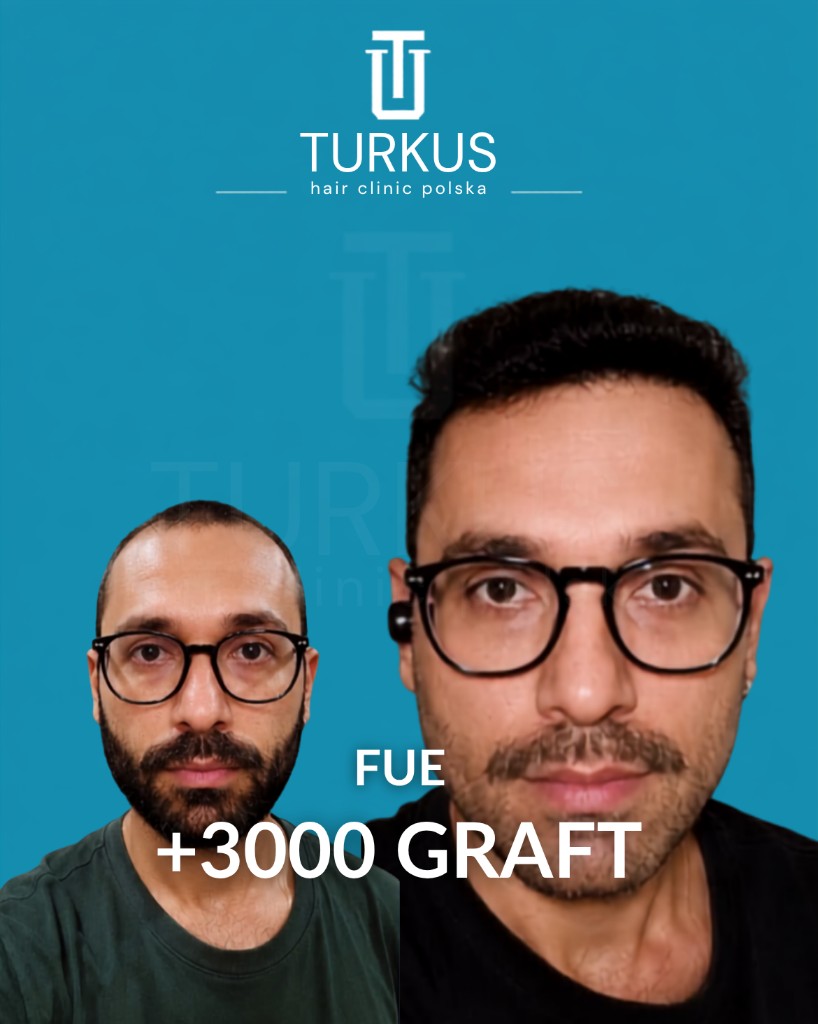 Krzysztof M. przed i po przeszczepie włosów FUE, 3.000 graftów, Norwood 3 w Turkus Hair Transplant Clinic.